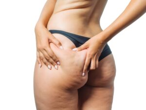 Read more about the article Cellulite is often misunderstood 